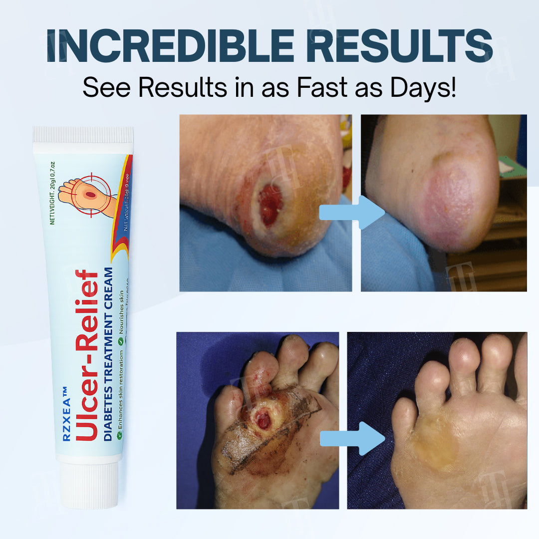 RZXEA™  Ulcer-Relief Diabetes Treatment Cream