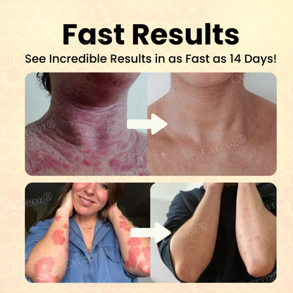 RZXEA™ Bee Venom Psoriasis Care Cream