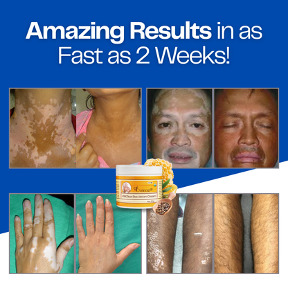 RZXEA™ VitiClear Bee Venom Cream