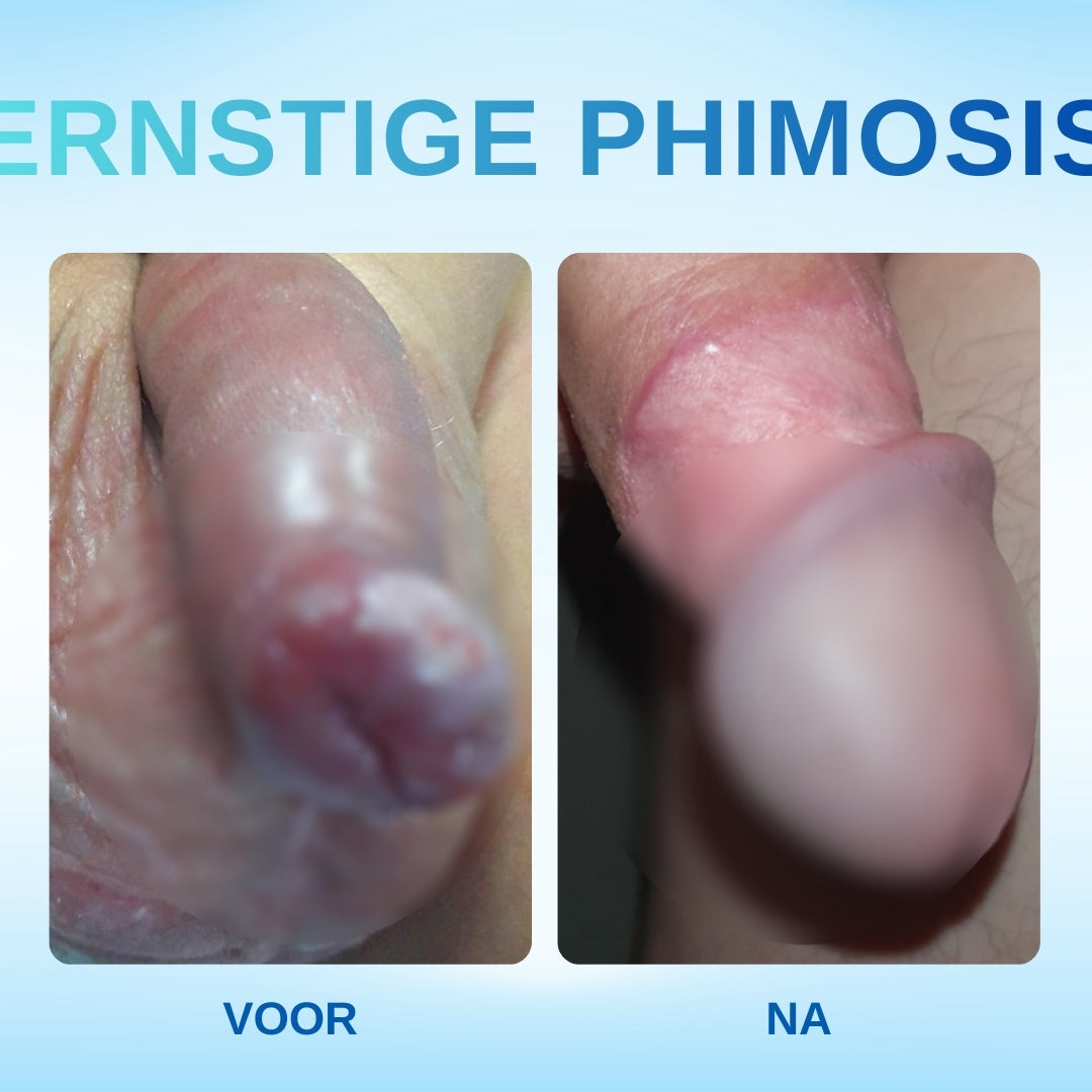 Rzxea™ Gel Tegen Overtollige Voorhuid