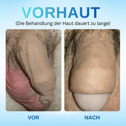 Rzxea™ Redundantes Präputium Korrektur Gel