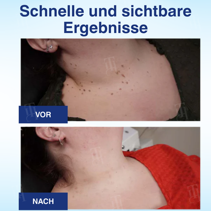 RZXEA™ AHA Warzenentfernungsflüssigkeit