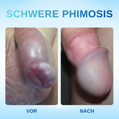Rzxea™ Redundantes Präputium Korrektur Gel