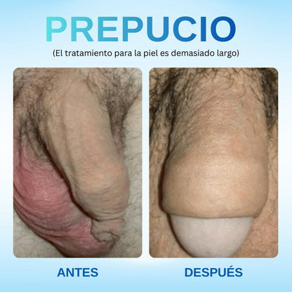 Rzxea™ Gel Corrector de Prepucio Redundante