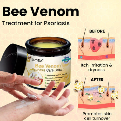 RZXEA™ Bee Venom Psoriasis Care Cream